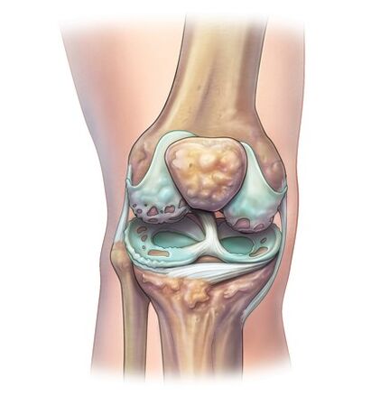 Distrugerea articulațiilor odată cu dezvoltarea osteochondrozei