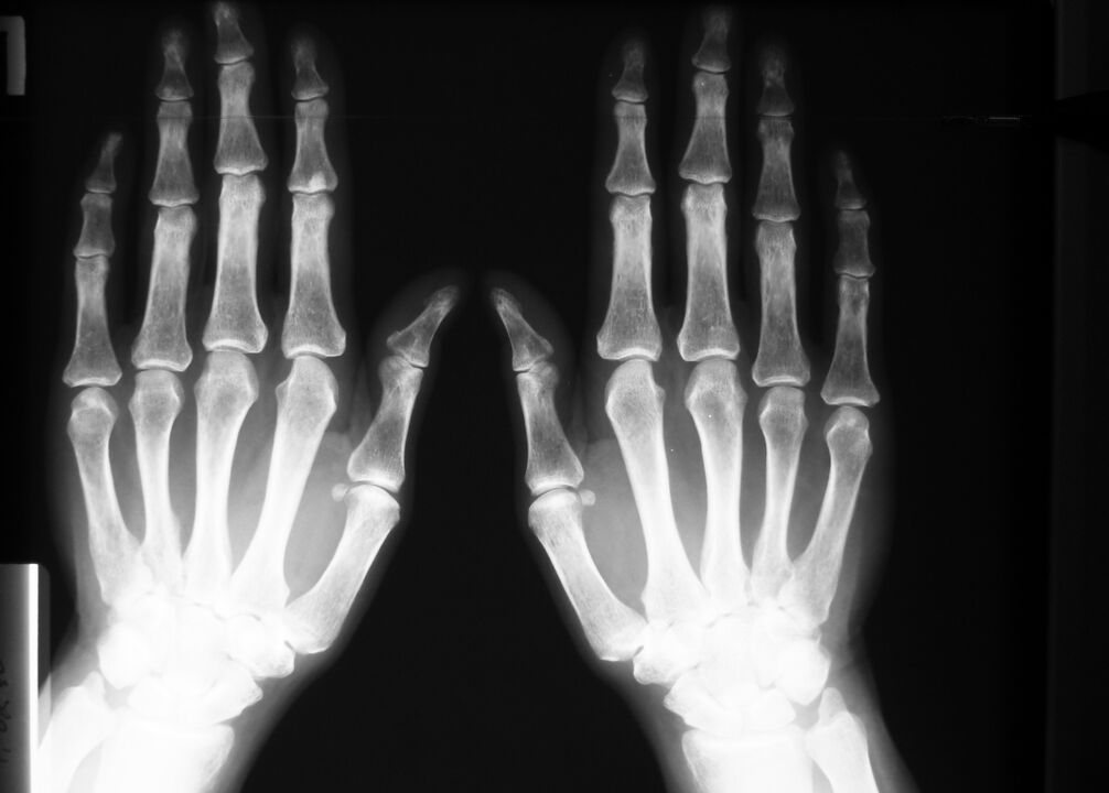 radiografie pentru a diagnostica durerea în articulațiile degetelor