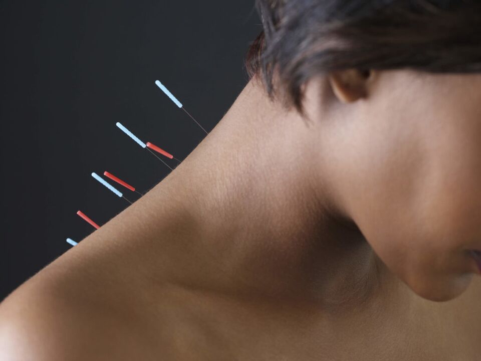 Acupunctura pentru osteocondroza cervicală elimină procesele inflamatorii